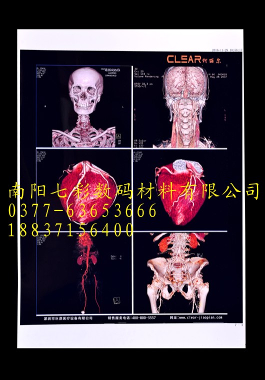 嘉峪關(guān)醫(yī)用噴墨膠片蘭州醫(yī)用藍(lán)基白基B超CT激光X線膠片